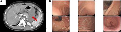 Idiopathic Spontaneous Intraperitoneal Hemorrhage Due to Vascular Malformations in the Muscularis of the Stomach: A Case Report